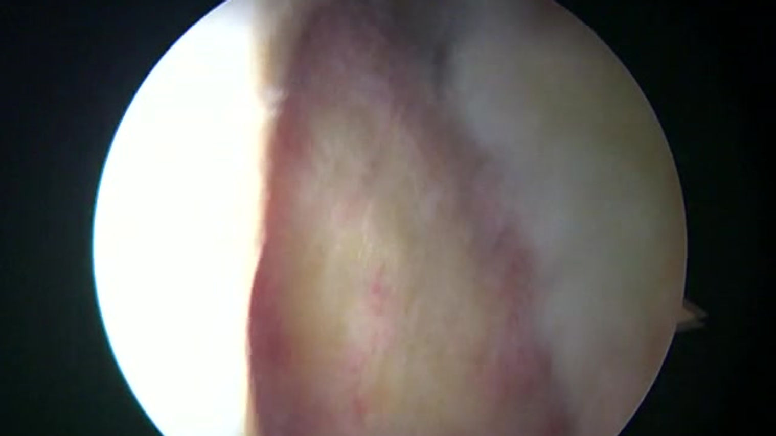 Labral Repair